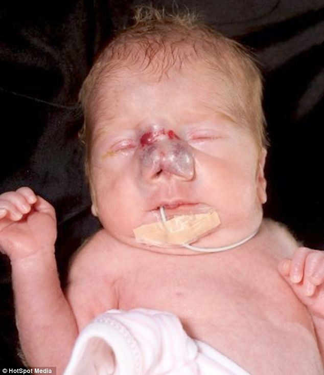 Sau đó, các bác sĩ đã chẩn đoán Zoe Mitchell bị một khối u mạch máu lành tính trong da.