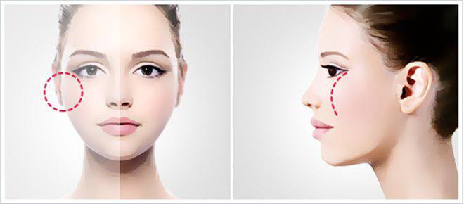 Xương gò má cao: Phụ nữ có gò má cao thường tính cách mạnh mẽ, phóng khoáng, sống độc lập tự chủ. Họ là những người tài giỏi, cũng ưa tự do, hiếm khi chịu sự ràng buộc của gia đình, càng không thích bị hôn nhân bó buộc.