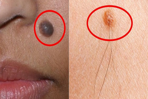 Lông mọc trên nốt ruồi. Có lông mọc trên nốt ruồi là một điềm báo may mắn. Người xưa có câu: "Một lông cô quạnh, ba lông chủ phát tài". Vì vậy, nếu chỉ có một sợi lông mọc trên nốt ruồi thì không mang lại nhiều tài lộc cho chủ nhân. Ngược lại, nếu nhiều sợi lông mọc trên nốt ruồi thì có là dấu hiệu tài lộc.