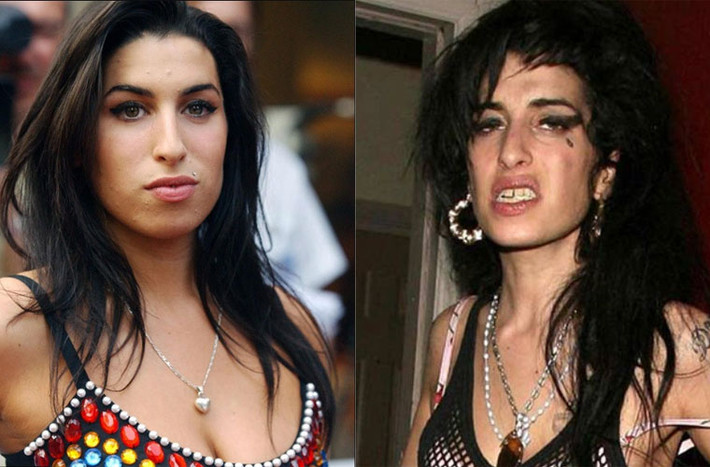 Họa mi Anh quốc Amy Winehouse nghiện nặng tới mức cô phải dùng hỗn hợp cocaine, ecstasy, ketamine, heroin và rượu mới đủ đô. Thói nghiện đã khiến khắp người cô lúc nào cũng đầy vết thâm tím. Năm 2011, Amy qua đời vì ngộ độc rượu.