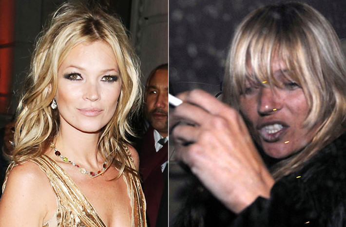 Ma túy đã khiến da và răng của Kate Moss xấu thảm hại. Scandal nghiện heroin của siêu mẫu Anh quốc bị phát hiện vào năm 2005 đã khiến cô bị mất rất nhiều hợp đồng với các thương hiệu lớn như Burrberry, H&M và Chanel.