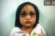 Bàng hoàng nhìn thương tích bé gái bị cha đánh đập