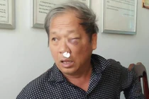 Đọc gì hôm nay 28/1: Đứt lìa tay khi hỗn chiến tại quán cà phê