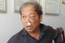 Đọc gì hôm nay 28/1: Đứt lìa tay khi hỗn chiến tại quán cà phê