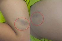 Phụ huynh 'tố' cô giáo đánh con bầm tím trong giờ học