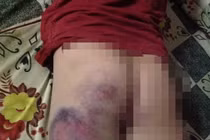 Cô giáo đánh tím mông học sinh lớp 4 vì không biết viết