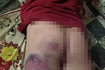 Cô giáo đánh tím mông học sinh lớp 4 vì không biết viết