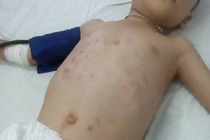 Bé trai 5 tuổi ở Huế bị người tình của mẹ bạo hành dã man