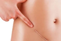 Những tai họa nào chờ đợi bạn khi phẫu thuật hút mỡ?