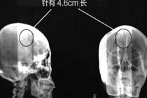 Kỳ lạ kim khâu nằm trong đầu mà không hay biết