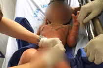 2 bé bị bỏng nặng vụ cô giáo dùng cồn dạy PCCC đã được ghép da