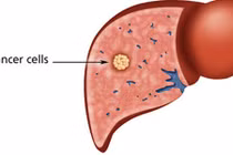 Điểm danh 10 căn bệnh ung thư nguy hiểm nhất 