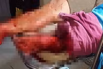 Bị nói "chém gió" thanh niên 17 tuổi chém đứt lìa chân người khác