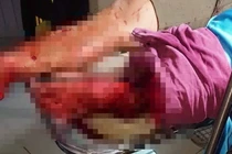 Bị nói "chém gió" thanh niên 17 tuổi chém đứt lìa chân người khác