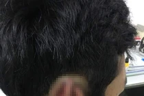 Hy hữu: Nối lại tai cho nam sinh bị bạn cắn đứt rồi nuốt vào bụng