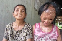 Ảnh: Những vụ án tạt axit thương tâm gây rúng động dư luận