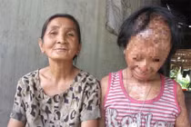 Ảnh: Những vụ án tạt axit thương tâm gây rúng động dư luận