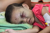 Những vết thương kinh hoàng trên người bé gái bị cha mẹ hành hạ