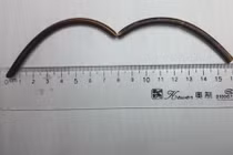 Kinh hãi dị vật nằm suốt 20 năm trong tá tràng