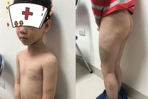 Hà Nội: Nghi vấn bố đánh con đẻ 7 tuổi bầm tím