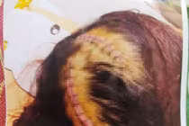 Sắp ly hôn, chồng dùng cuốc cuốc thẳng vào đầu vợ