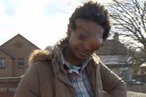 Thảm cảnh gái xinh biến dạng vì khối u trùm kín mặt