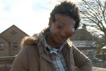 Thảm cảnh gái xinh biến dạng vì khối u trùm kín mặt