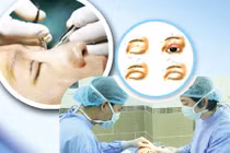 Biến chứng khủng khiếp do cắt mí, bấm mí mắt