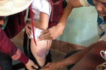 Cô giáo đánh học sinh lớp 4 tím mông vì không biết viết