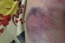 Vết thương bầm tím của học lớp 4 ở Đắk Lắk do đâu?