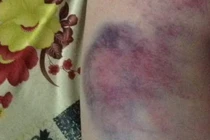 Vết thương bầm tím của học lớp 4 ở Đắk Lắk do đâu?