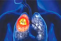 2 vợ chồng cùng mắc ung thư, bác sĩ chỉ nguyên nhân 