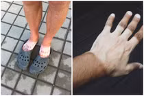 “Thảm cảnh” cháy nắng không đỡ được vì coi thường cái nắng hè