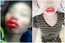 “Sang chấn tâm lý” với thảm họa phun xăm môi làm netizen ám ảnh