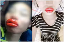 “Sang chấn tâm lý” với thảm họa phun xăm môi làm netizen ám ảnh