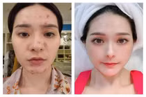 Lộ gương mặt chi chít lỗ “nữ đại gia quận 7“ làm netizen sợ