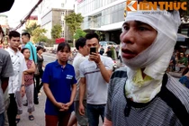 Công nhân bị bỏng kể về vụ cháy kinh hoàng ở xưởng gỗ