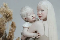 Diện mạo khác lạ của hai chị em bị bạch tạng “nổi như cồn” 