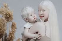 Diện mạo khác lạ của hai chị em bị bạch tạng “nổi như cồn” 