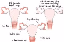 Cắt tử cung có ảnh hưởng chuyện phòng the?