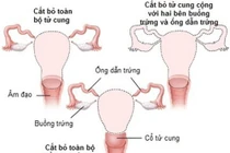 Cắt tử cung có ảnh hưởng chuyện phòng the?