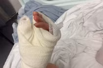 Kinh hoàng bệnh lạ khiến người mẹ phải cắt từng phần của ngón tay suốt 6 năm