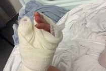 Kinh hoàng bệnh lạ khiến người mẹ phải cắt từng phần của ngón tay suốt 6 năm