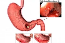 Sau một đêm không ngủ để làm điều này, vợ trẻ nôn ra máu phải cấp cứu