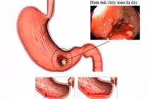 Sau một đêm không ngủ để làm điều này, vợ trẻ nôn ra máu phải cấp cứu
