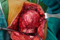 Kinh dị cắt u xương cánh tay to như quả bóng ở HN 