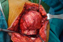 Kinh dị cắt u xương cánh tay to như quả bóng ở HN 