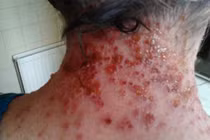 Nhập viện vì dùng lá cây thải độc thuốc Tây 