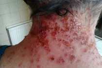 Nhập viện vì dùng lá cây thải độc thuốc Tây 