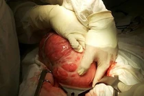 Bé gái bị nghi có thai vì khối u gần 6kg trong bụng